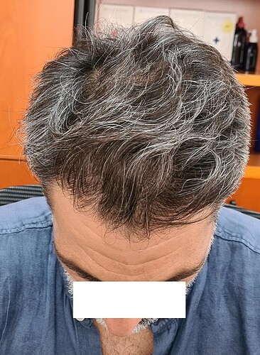 Enhancement of density to top and crown with 2900 Grafts only – HDC Hair Clinic photo