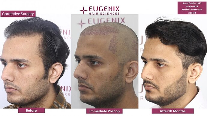 Corrective Hair Transplantation | Hairline Correction I 7 months update @Eugenix Hair Sciences photo