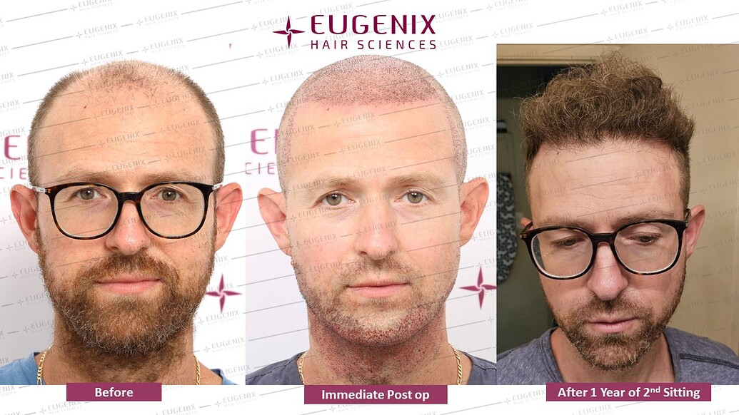 https://cdn.forumhairtransplant.com/optimized/3X/a/2/a20375dd3fc34f122d9419affc84f78ccca1b874_2_1035x582.jpeg