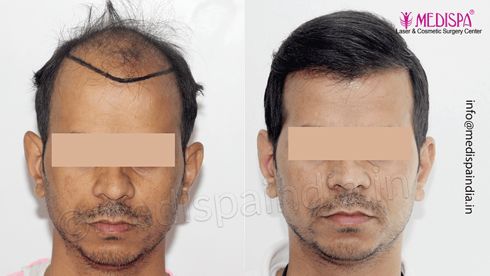 Dr. Suneet Soni - 4533 Grafts, Combine FUT + FUE Technique , NW-IV/V photo