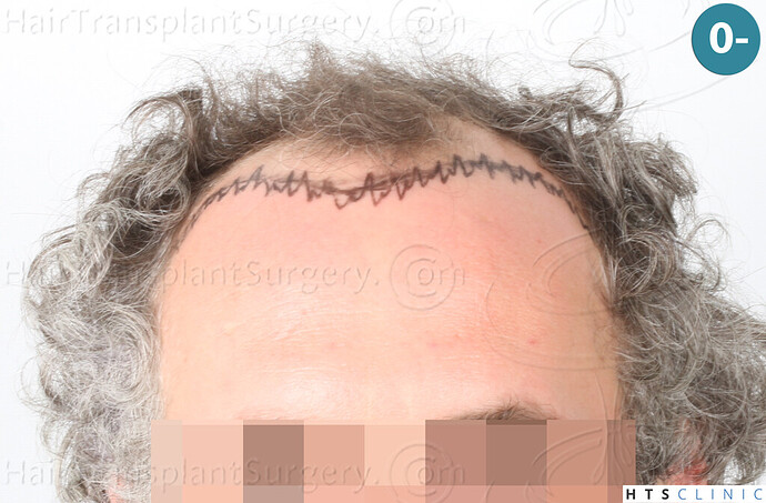 Dr Devroye + Dr Montesanti + Dr Jenard, HTS Clinic / 2932 FUE / Hairline & frontal area photo