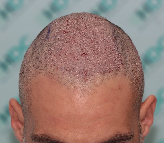 Enhancement of density to top and crown with 2900 Grafts only – HDC Hair Clinic photo