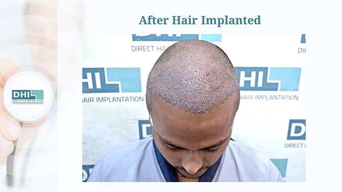 DHI India™ | NW 4 | 4,265 Grafts | 6-Months DHI™ Hair Transplant Results photo