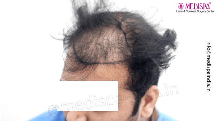 Dr. Suneet Soni - 5467 Grafts, Combine FUT + FUE + Beard Technique, NW- V, 3 Years Result photo