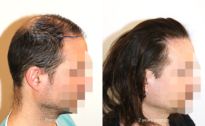 Case performed by Dr. Feriduni – 3346 FU in 1 procedure photo