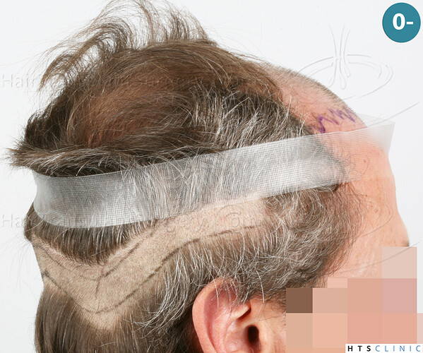 Dr Devroye + Dr Montesanti + Dr Jenard / 7015 grafts (4512 FUT + 2503 FUE) / 2 sessions photo