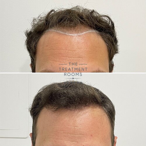 Crown and Hairline 1736 Grafts FUE Hair Transplant Result photo