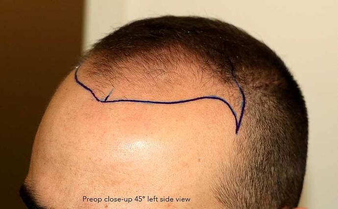 Case performed by Dr. Feriduni – 3505 FU in 1 procedure photo