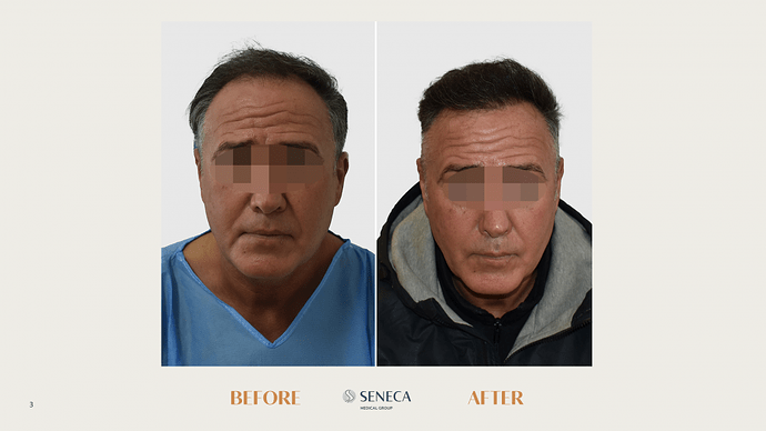 Seneca Medical Group - 2.608 grafts with Direct FUE (10 months result) photo