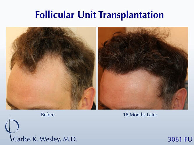 #BAM Natural Flow to a Hairline (3061 grafts): Carlos K. Wesley, M.D. (NYC & LA) photo
