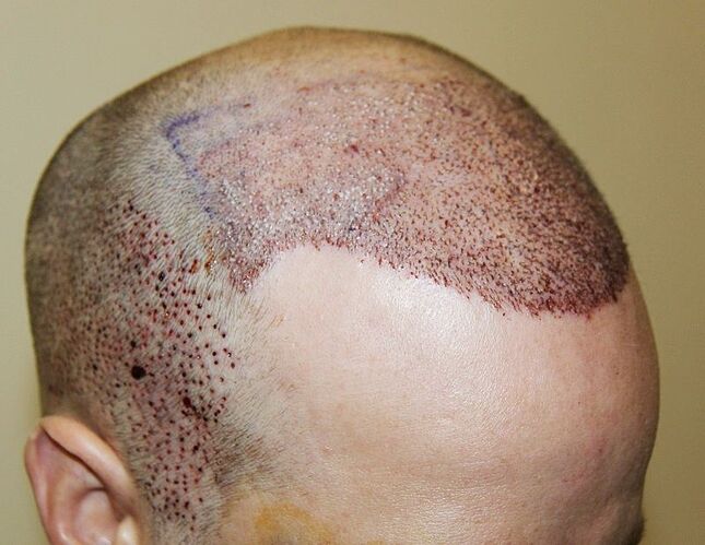Dr. Bisanga - BHR Clinic / 2691 FUE - Frontal Repair / Manual Punch photo