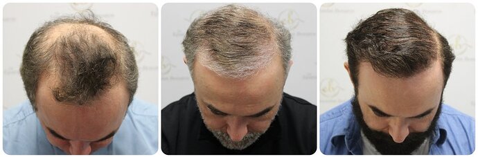 Dr Bonaros, Glasgow, UK / 3986 FUE grafts / 0-12 Months photo