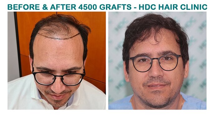 HDC Hair Clinic – FUE Hair Transplant Result for 4534 Grafts photo