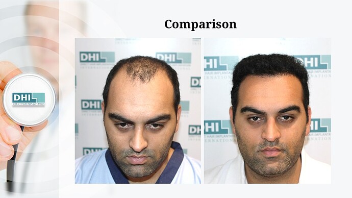 DHI India | NW 5 | 3,080 Grafts | 20-Months DHI Hair Transplant Results photo