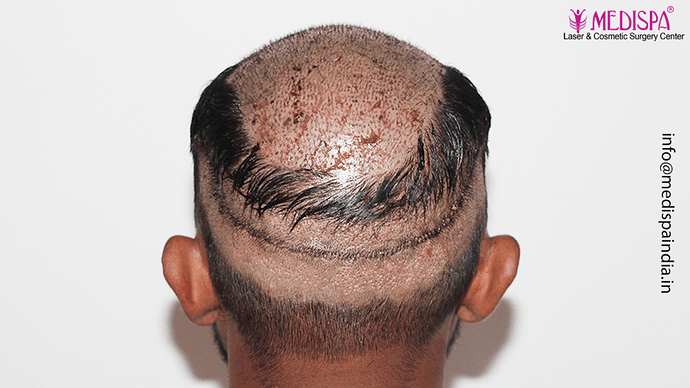 Dr. Suneet Soni - 5360 Grafts | 12-Month Result | Combination FUT + FUE + Beard photo