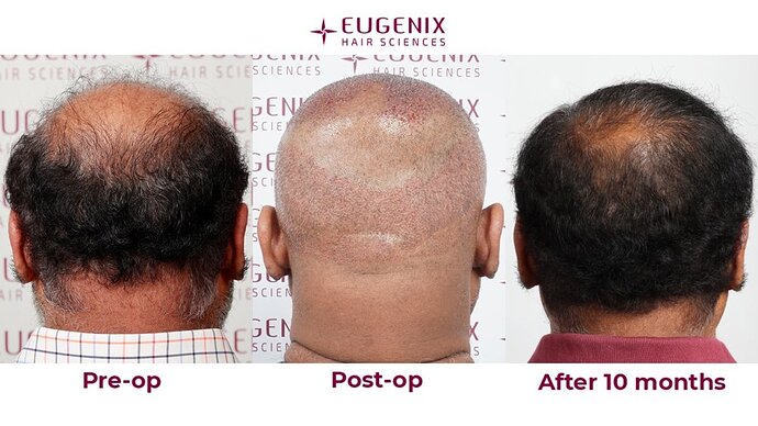 Eugenix Hair Sciences| NW 7 | 6309 Grafts | 10 Months Post-op| Dr. Pradeep Sethi photo