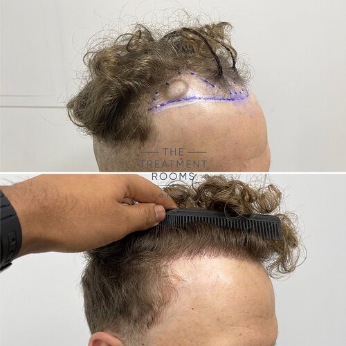 1514 Grafts Hairline Hair Transplant- The Treatment Rooms London photo