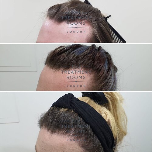 2 Stage FUE Hair Transplant- Hairline Feminisation- 2319 Grafts photo