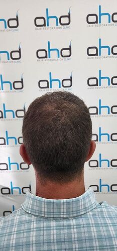 DR HAKAN DOGANAY/ 3625 GRAFTS (3000 from head + 625 from beard) / Implanter Pen+FUE photo
