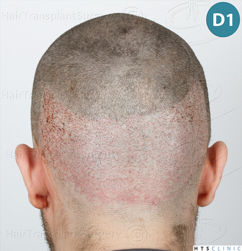 Dr. Jean Devroye, HTS Clinic / 2101 FUE / Temple corners restoration photo