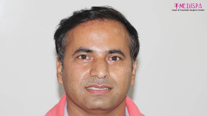 11600 Grafts in 3 FUT Sittings by Dr Suneet Soni photo