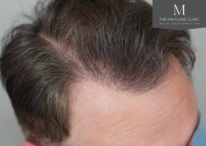 Dr Ball - The Maitland Clinic 2032 Grafts By FUE photo