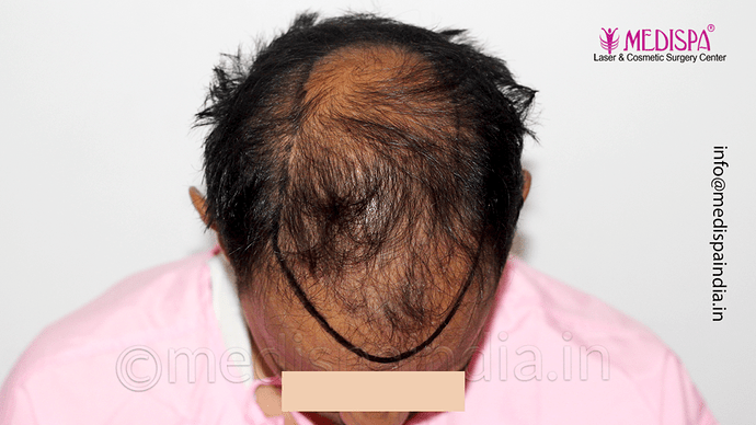 Dr. Suneet Soni - 4533 Grafts, Combine FUT + FUE Technique , NW-IV/V photo