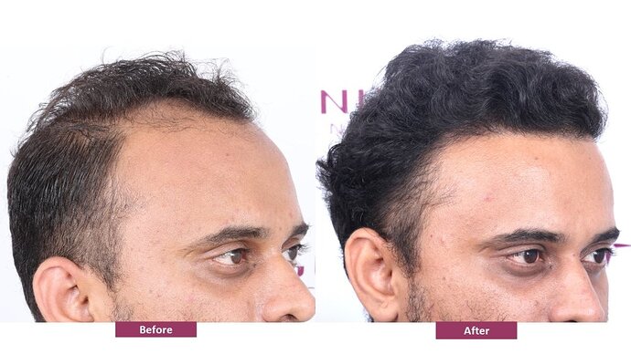 Eugenix Hair Sciences Clinic | Norwood Grade 3 | 22 Months Hair Transplant Results| photo