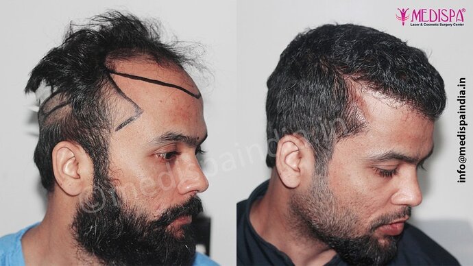 Dr. Suneet Soni - 5320 Grafts, Combine FUT + FUE Technique , NW- IV photo