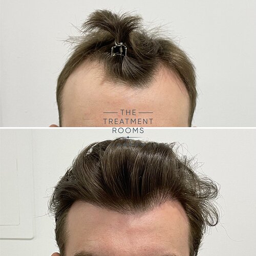 1357 Grafts Hairline & Temple Restoration photo