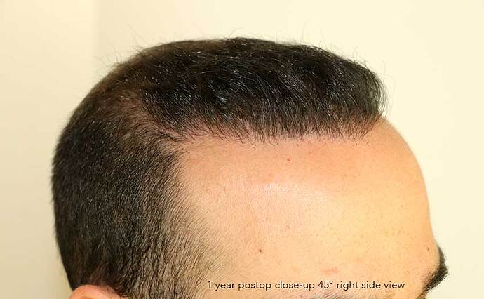 Case performed by Dr. Feriduni – 3505 FU in 1 procedure photo