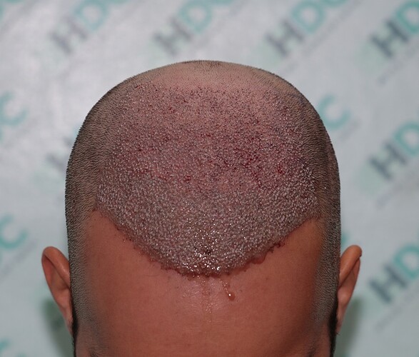 Result of 4900 Grafts on NW5 Patient – 8 Months After – Dr Maras – HDC Hair Clinic photo