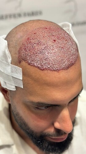 Dr Fares Seffen (Tunis, Tunisia) 3760 FUE results (Diffuse NW 4) Day 0 --> 10 Months after photo