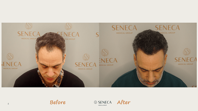 Seneca Medical Group - 2065 grafts with Direct Fue photo