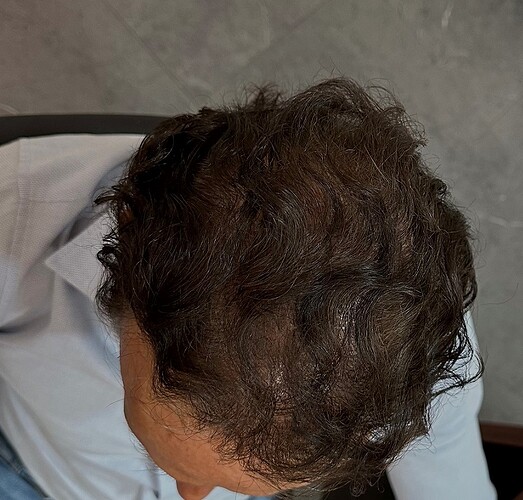 Hair Transplant Outcome with 4000 Grafts Across NW5 Zone – HDC Hair Clinic photo