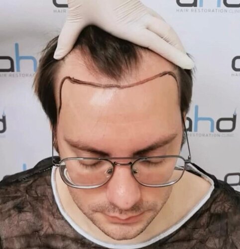 DR HAKAN DOGANAY/ 3600 GRAFTS / Implanter Pen+FUE photo