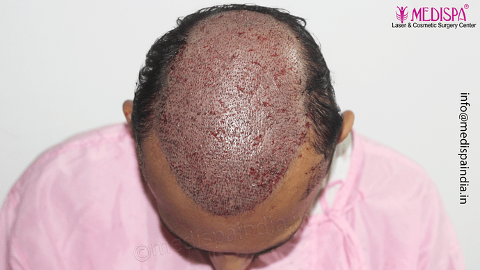 Dr. Suneet Soni - 4665 Grafts, Combine FUT + FUE + BHT (Beard) Technique photo