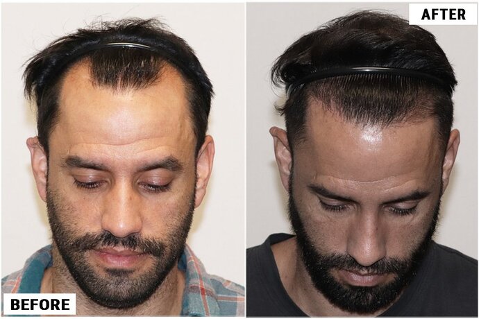 Dr. John Cole - Forhair Clnic Atlanta - FUE 2930 grafts Results photo