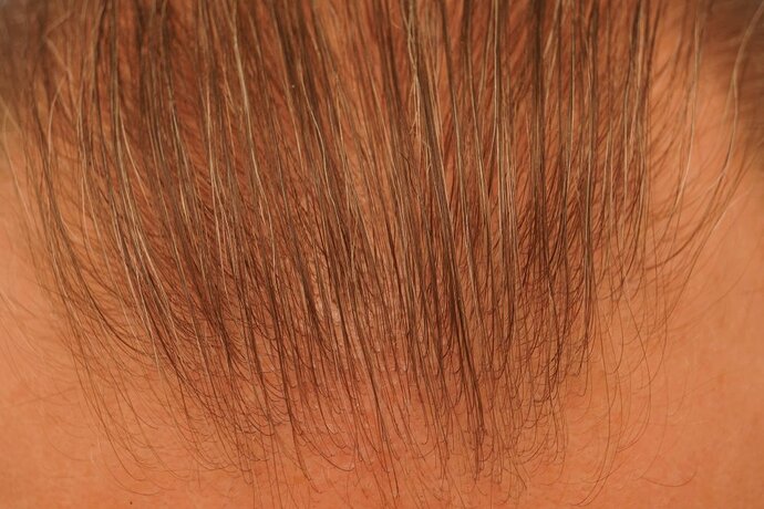 Dr B Farjo 1700g FUE (Front) photo