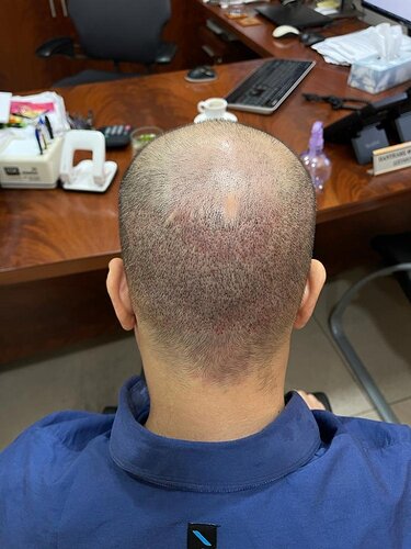3400 grafts on a Diffuse Thinning case – 1 year after - HDC Hair Clinic photo