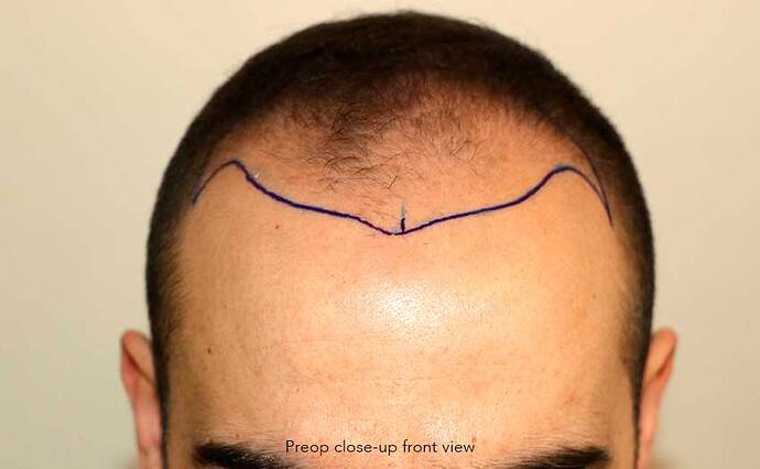 Case performed by Dr. Feriduni – 3505 FU in 1 procedure photo
