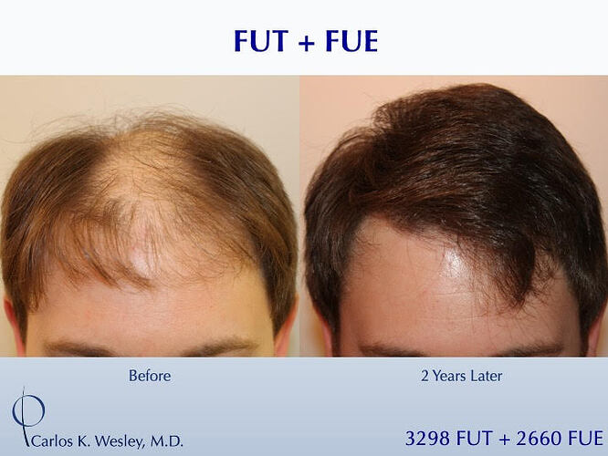 (Combined FUT 3298 & FUE 2660 grafts): Carlos K. Wesley, M.D. (NYC & LA) photo