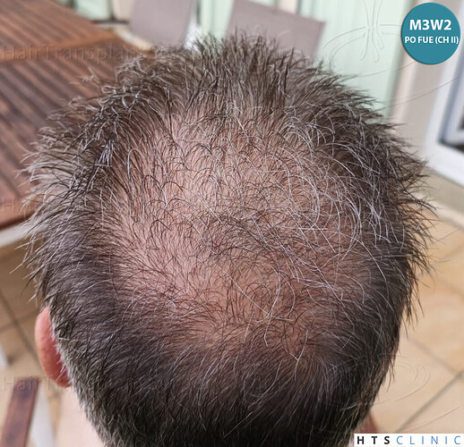 Dr Devroye + Dr Montesanti + Dr Jenard / 7015 grafts (4512 FUT + 2503 FUE) / 2 sessions photo