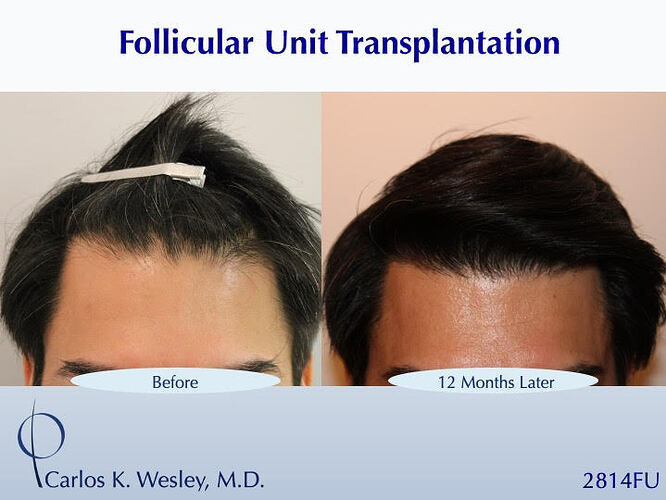 #BAM Stronger, Healthier Hairline (2814 FUT grafts): Carlos K. Wesley, M.D. (NYC & LA) photo