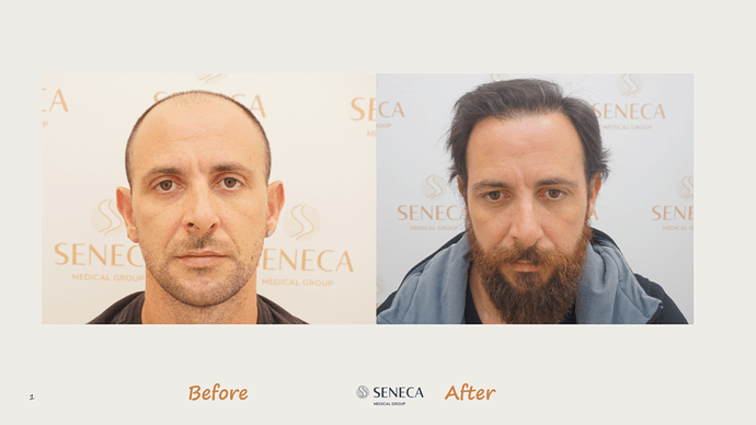 Seneca Medical Group - 3612 grafts with Direct Fue photo