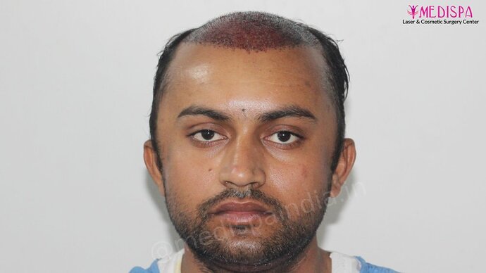 Dr. Suneet Soni - 5587 Grafts, Combine FUT + FUE + Beard Technique, NW : V-VI photo