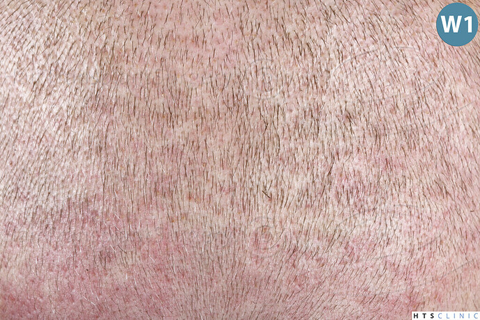 Dr. Jean Devroye, HTS Clinic / 6494 FUE-BHT (3150 + 3344) / NW VII, 2 sessions photo