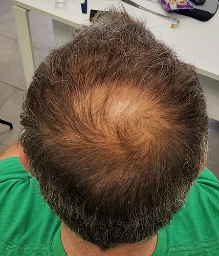 Result 3125 grafts – 10 months after – Top Coverage and Connecting top hair with side donor – HDC Hair Clinic – Dr Maras photo