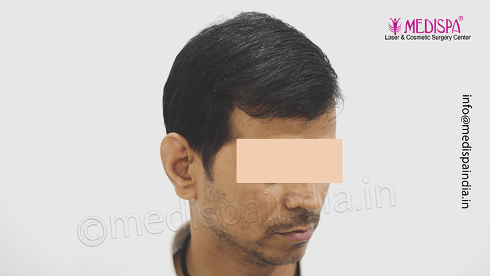 Dr. Suneet Soni - 4533 Grafts, Combine FUT + FUE Technique , NW-IV/V photo