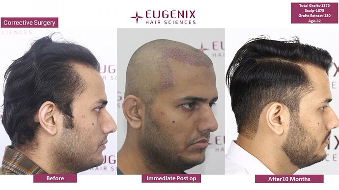 Corrective Hair Transplantation | Hairline Correction I 7 months update @Eugenix Hair Sciences photo